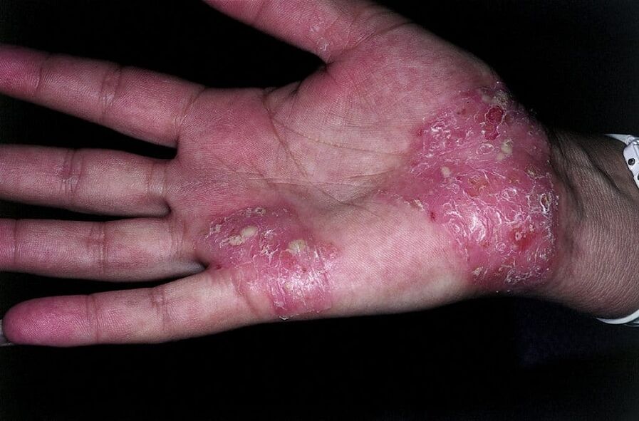 worsening of psoriasis on hands