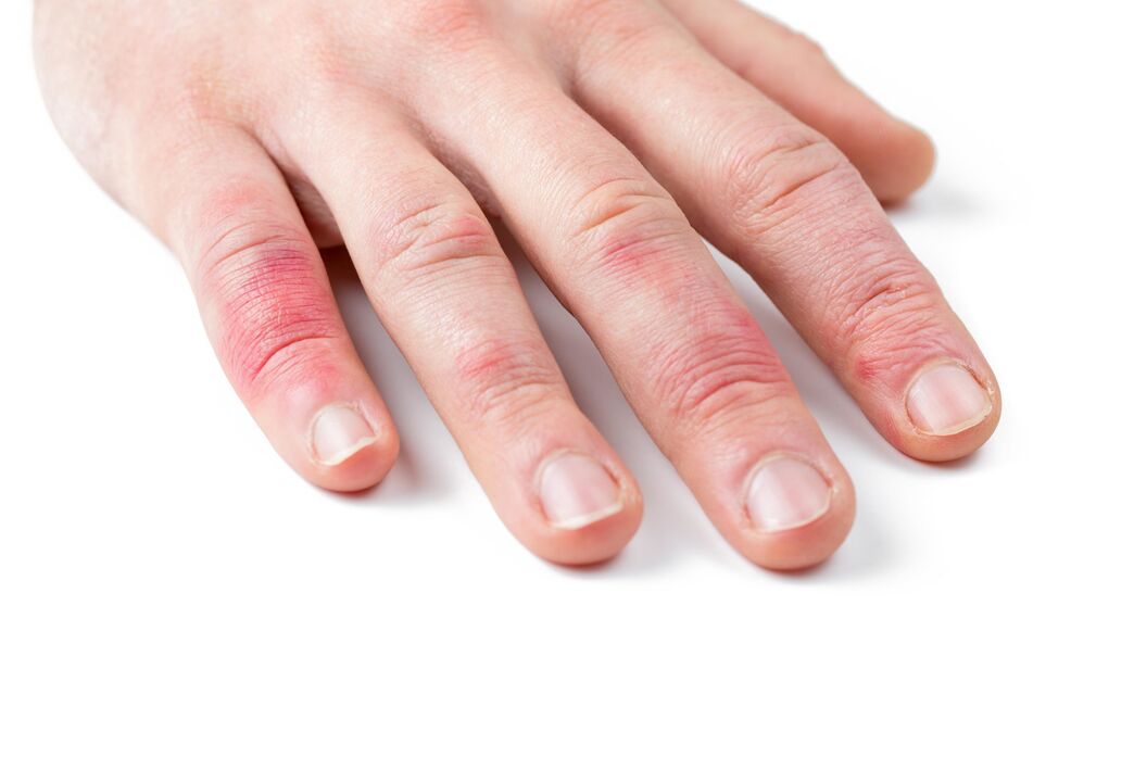 psoriasis on a child's hands