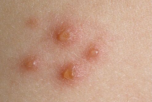 skin joints in psoriasis