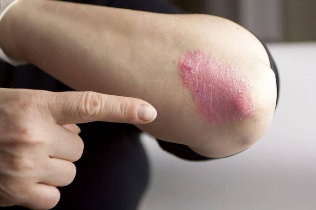 Manifestations of the initial stage of psoriasis of the elbow