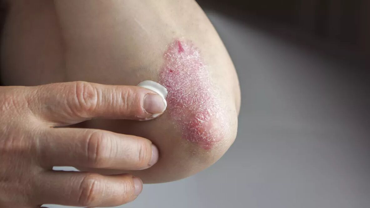 Psoriatic plaques on the elbow are treated with medicated cream