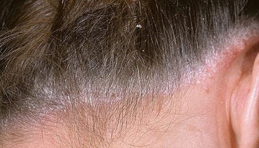 Psoriasis on the head