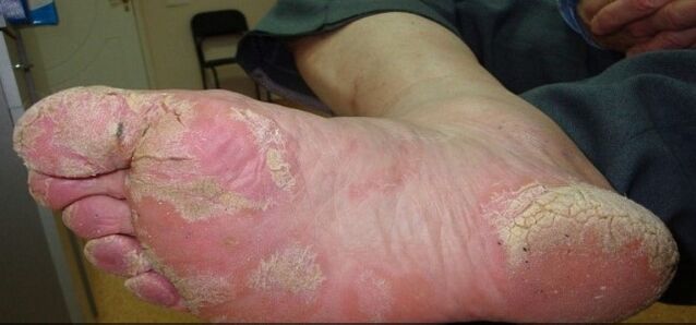 Psoriasis standing