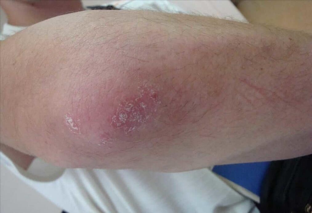 It looks like psoriasis