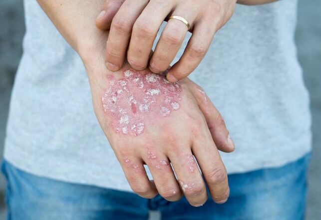 Mesnichered psoriasis