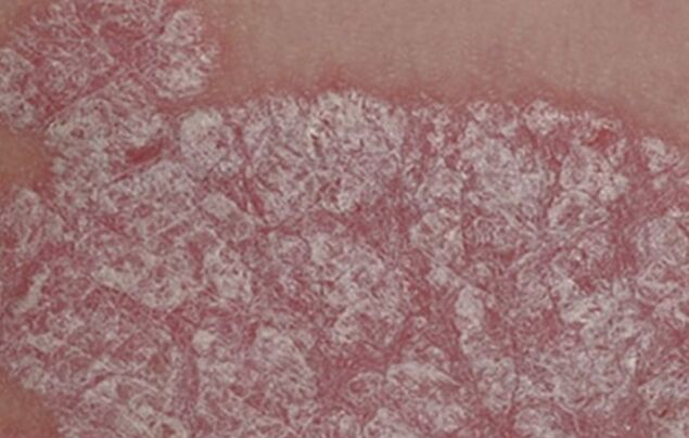 The healing of the papules
