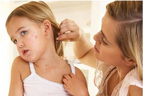 Psoriasis in children