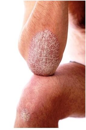 Psoriasis in elbow