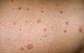 Psoriatic plaque