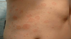 The unfortunate psoriasis