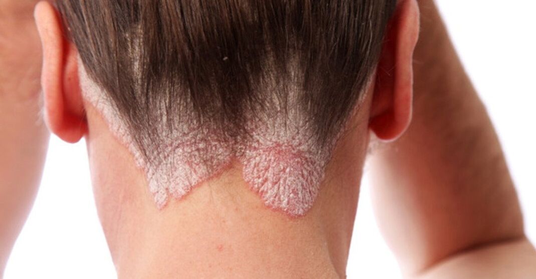 Psoriasis in the girls