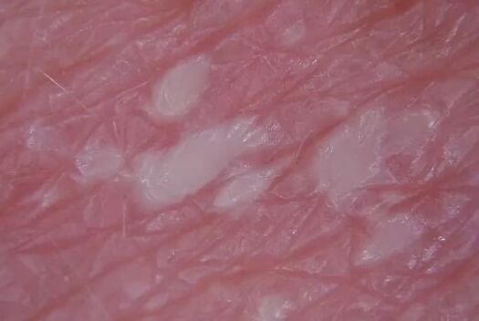 Psoriasis pustulenia