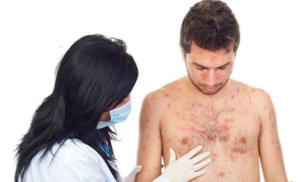 Psoriasis picture