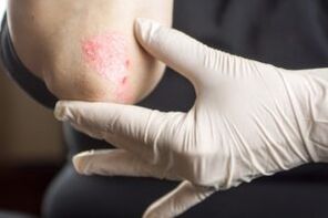 Psoriasis in elbow