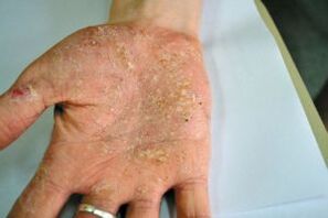 Psoriasis in the palm of your hand