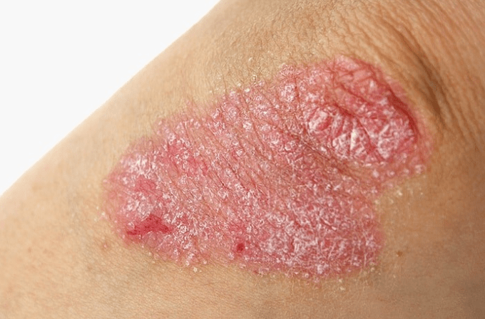 Progressive stage of psoriasis