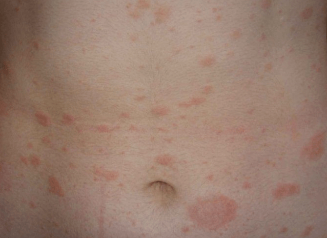 Regressive phase of psoriasis