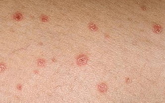 Psoriasis in the initial stage