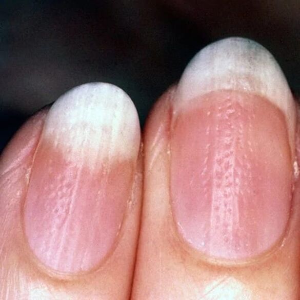 Psoriasis of the nails