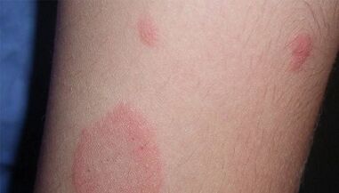 How is the initial stage of psoriasis manifested
