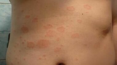 How to recognize the initial stage of psoriasis