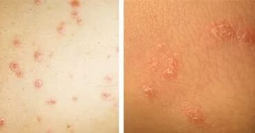 The main manifestations of psoriasis