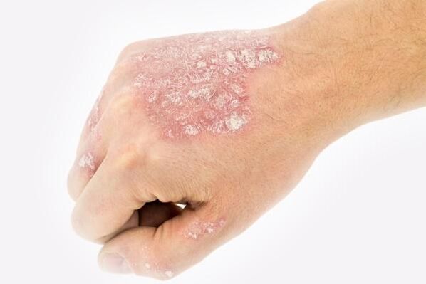 the mechanism of the development of psoriasis on the hands