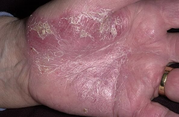 psoriasis in the palm