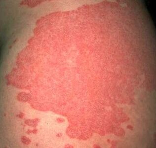 Joining psoriatic plaques