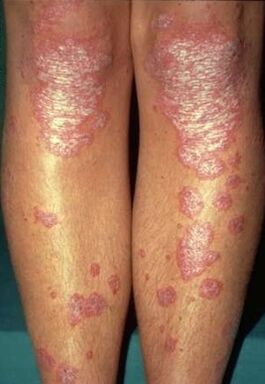 Manifestations of psoriasis of the foot