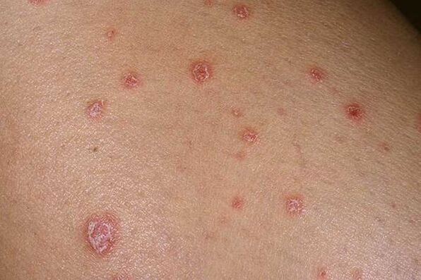 Small psoriatic outbreaks