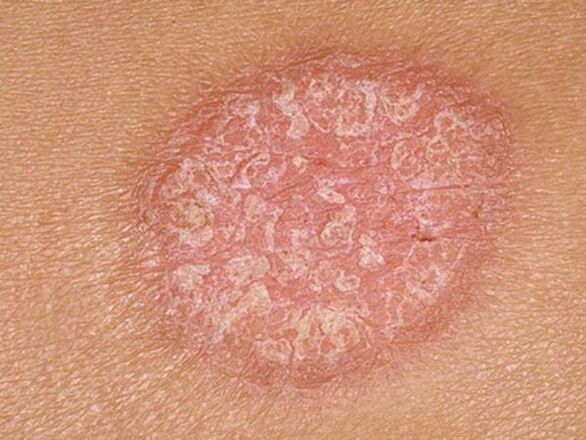 Stationary phase of papules