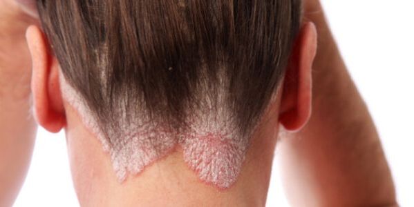 Well defined papules on the scalp