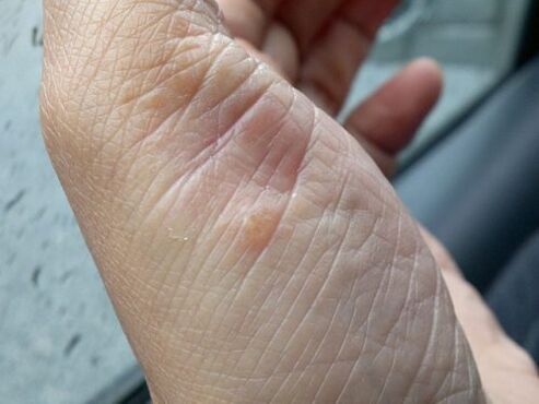 picture of psoriasis on the hand