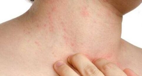 itching of the skin in the initial stage of psoriasis