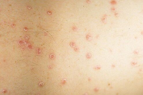 picture of the initial stage of psoriasis