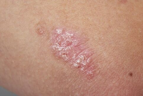 psoriatic plaques on the skin