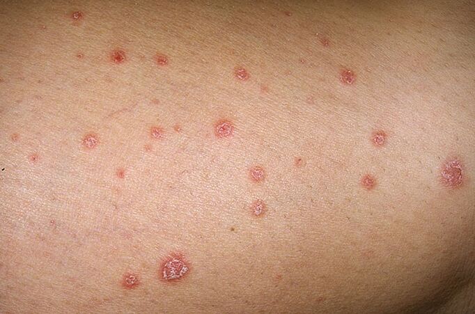 pictures of the first symptoms of psoriasis