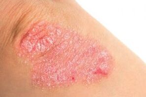 symptoms of psoriasis in the elbows
