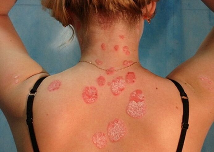 psoriasis of the neck and spine