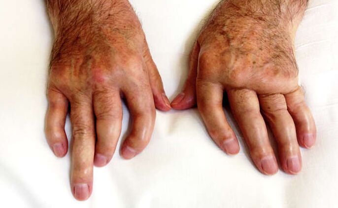 Arthritis mutilation in psoriasis