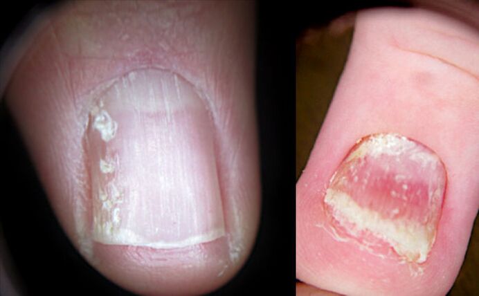 Cracked nails with psoriasis