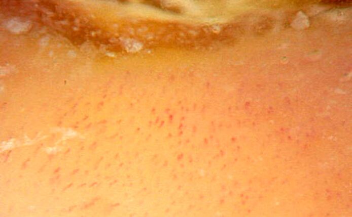 Dermatoscopy with 40x magnification that confirms psoriasis
