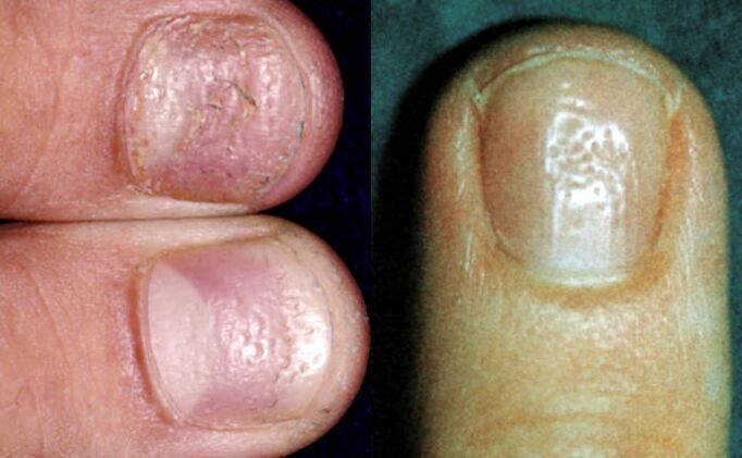 Exquisite symptom - multiple depressions on the surface of the nail plate