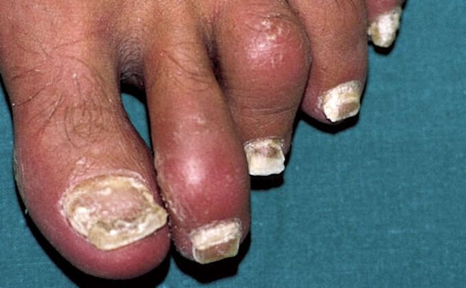Psoriasis of the nails and inflammation of the joints (arthritis) of the fingers
