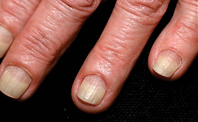 Spread of onycholysis from the edge of the nail to the fold of the nail