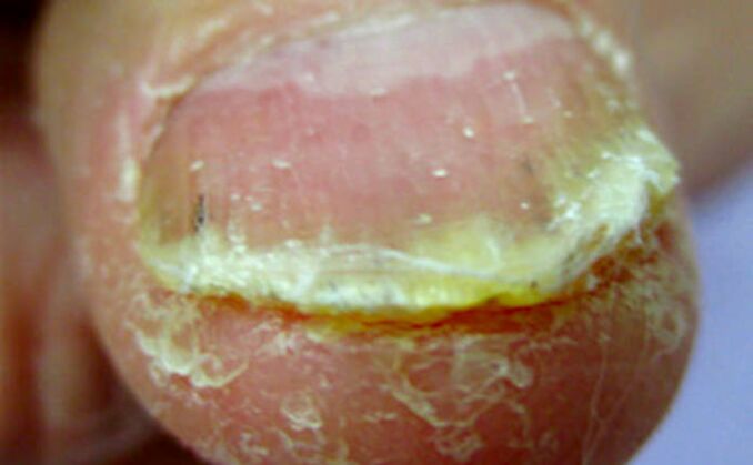 Subungual hyperkeratosis in the thumb