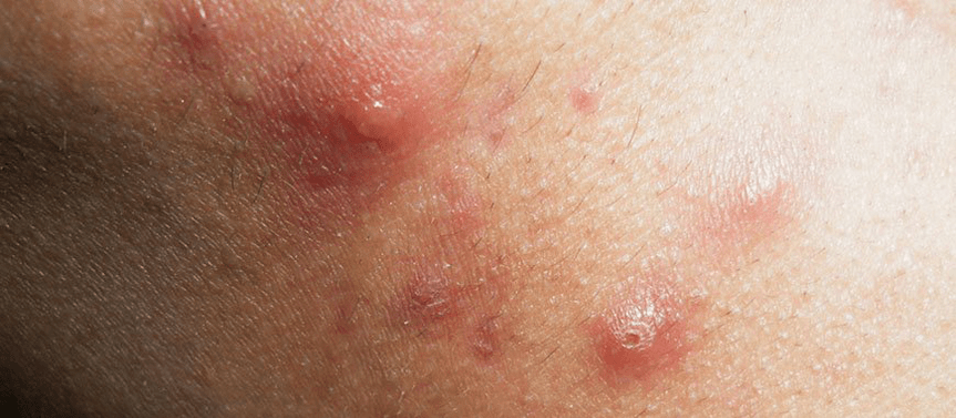onset of guttate psoriasis development in childhood