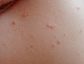 specify the symptom of rash psoriasis