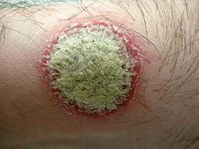 symptoms of coin rash psoriasis